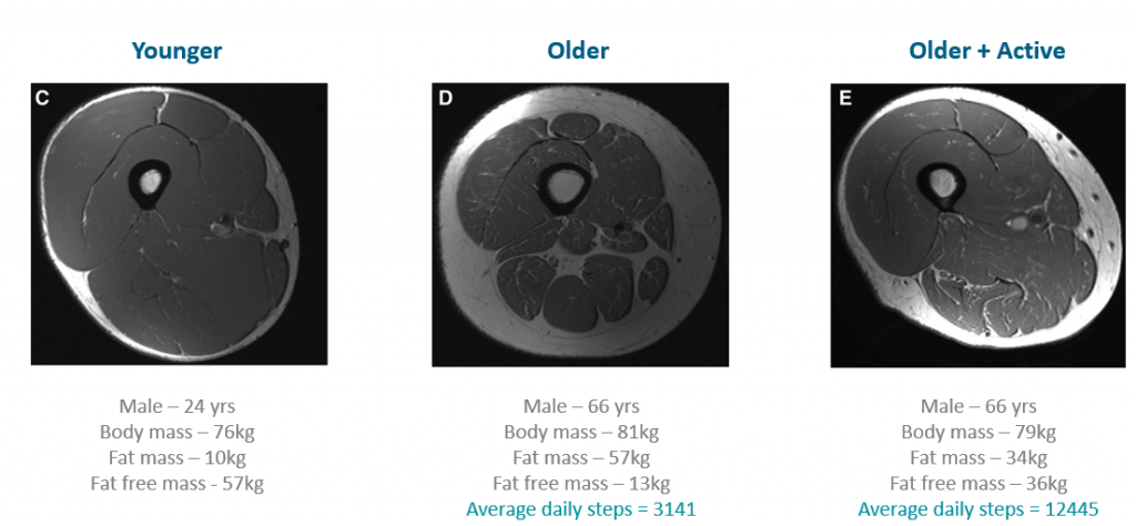 Cross-sections of muscle showing the impact physical inactivity can have on muscle mass during ageing. Taken from the webinar Active Ageing: Distinct Nutrition, Distinct Innovation?